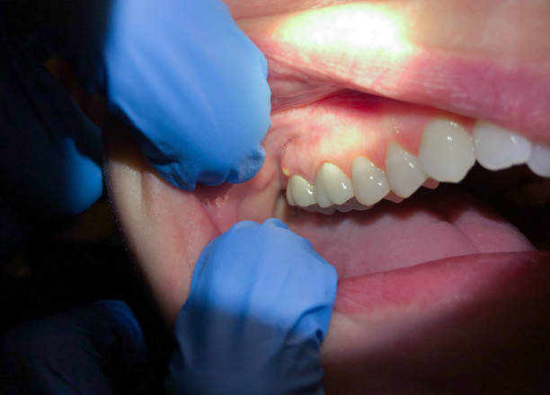 Best Emergency Dental Extractions in Chleston, AR